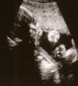 29 Week Ultrasound