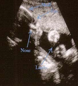 29 Week Ultrasound - Marked up