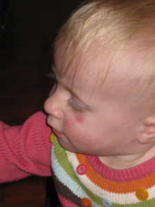 Profile view of Adria's new face scratches