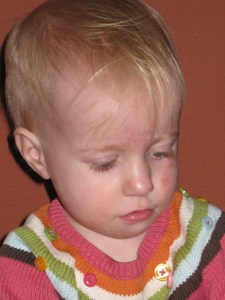 Portrait view of the scratches under her eye